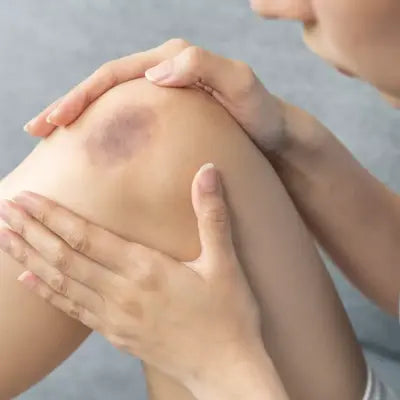 Personne avec une contusion sur le genou