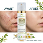 Crème BIO ACNYL avant-après : peau acnéique transformée en peau claire et radieuse
