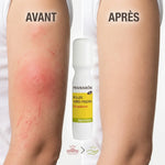 Roller après-piqûres Bio Pranarom avant/après, comparaison peau irritée et apaisée